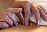 acupuntura-25-de-marco-1355232480