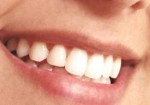 implantes-dentarios-25-de-marco-1355236283